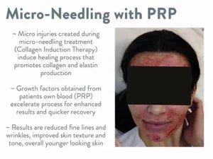 Microneedling with PRP Facial at Marco Med in Corona, CA