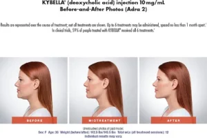 Kybella before and after images | Marco Med in Corona, CA